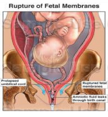 Memoire Online - La fréquence de la rupture prématurée des membranes. Etude  menée à la maternité Bomoi du 01 janvier au 31 décembre 2011. - CÃ©dric  BISEMBO WA BISEMBO MANTEZOLO