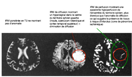 Memoire Online - L'IRM de diffusion et de perfusion dans l ...